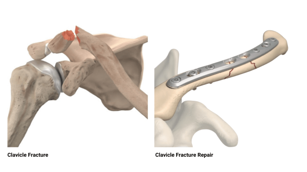 clavicle bone fracture