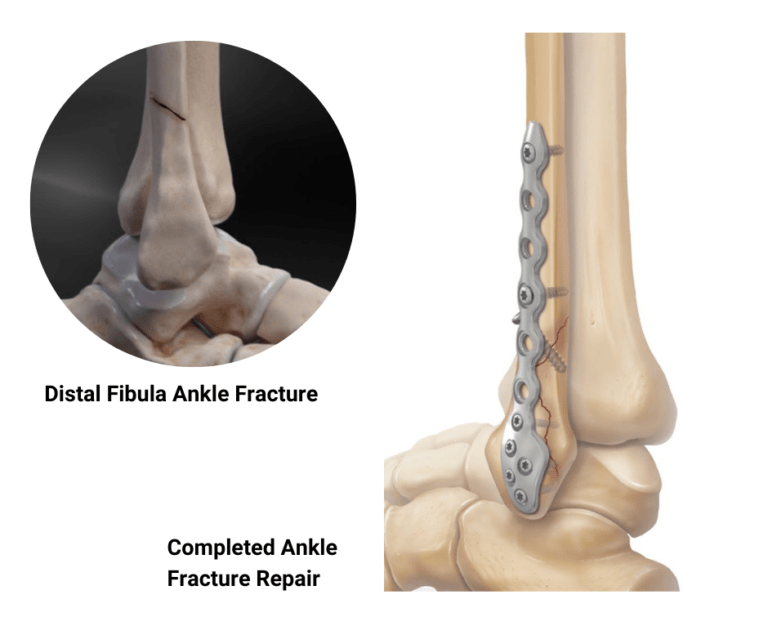 Fractured Fibula | Hartford Hospital | Hartford, CT