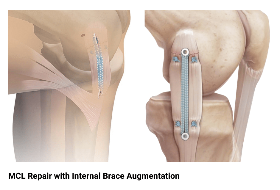 Medial Collateral Ligament (MCL) Tears