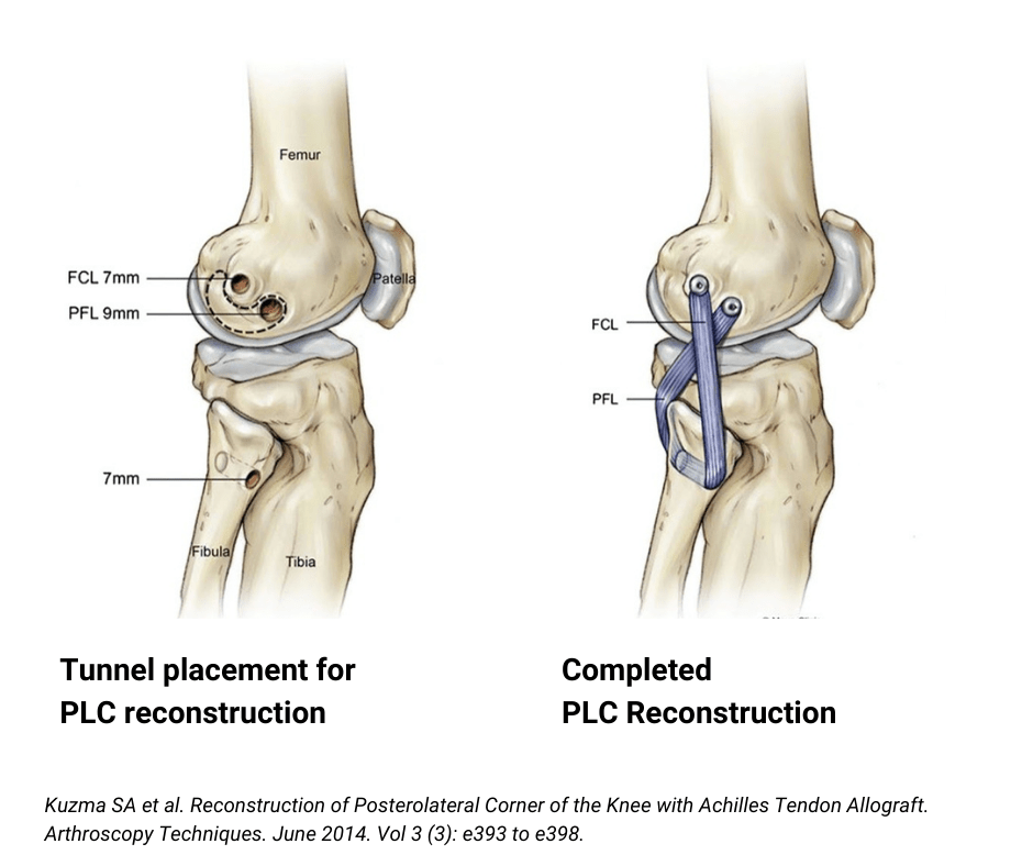 LCL Injury, FCL, Lateral Collateral Ligament, Orthopedic Knee Specialist