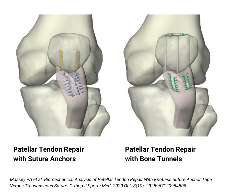 Patellar Tendon Ruptures